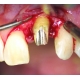 Dłuto periodontologiczne Dr. A. Suleana